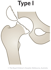 ED Section 1 FEMORAL NECK FRACTURE Type 1 ED Section 1 FEMORAL NECK FRACTURE Type 1